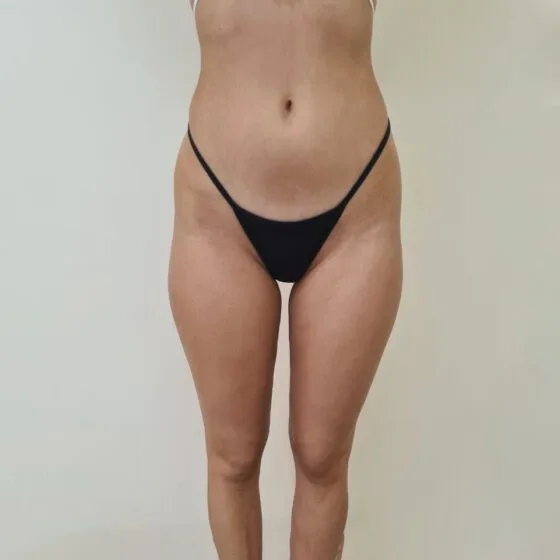 До/після процедури