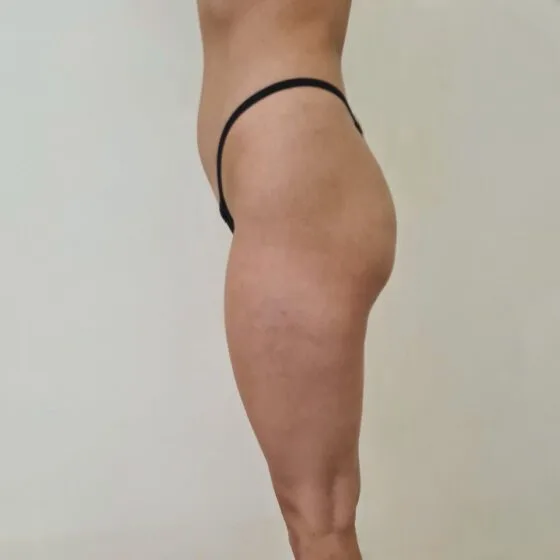 До/після процедури