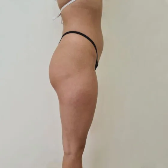 До/після процедури