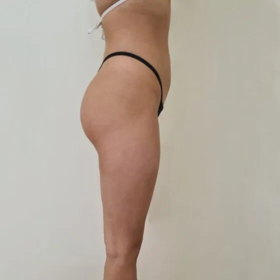 До/після процедури