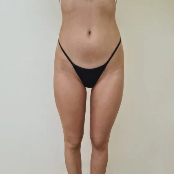 До/після процедури