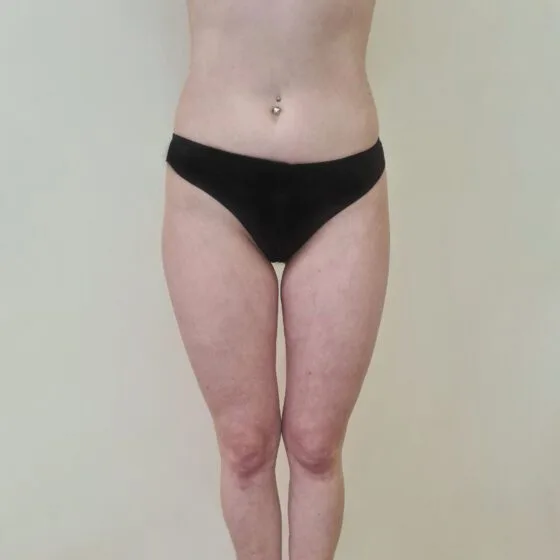 До/після процедури