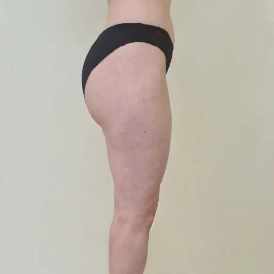 До/після процедури