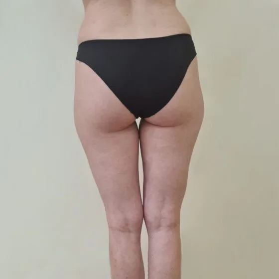 До/після процедури