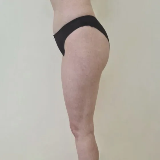 До/після процедури