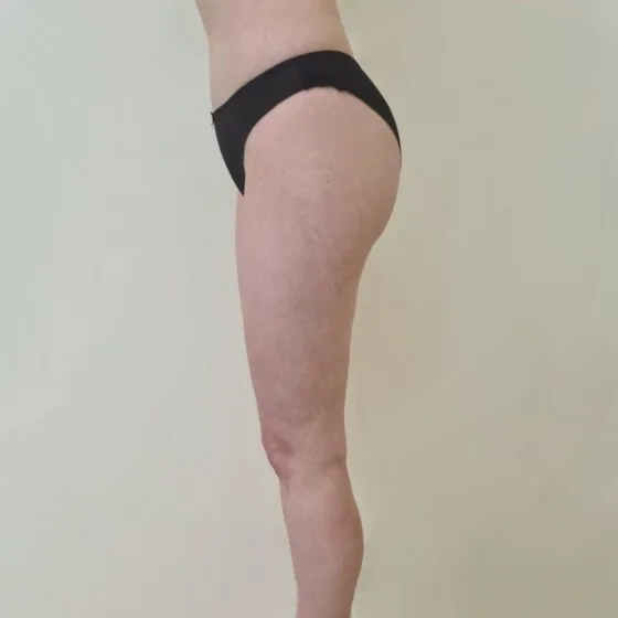 До/після процедури