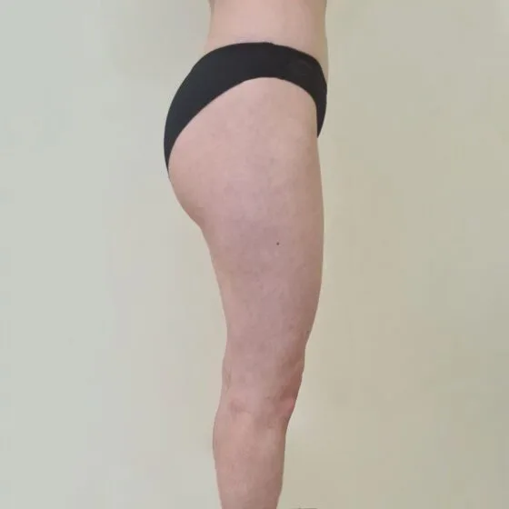 До/після процедури