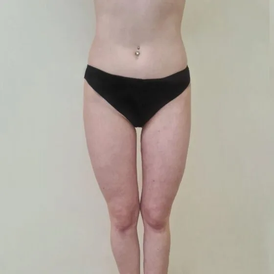 До/після процедури