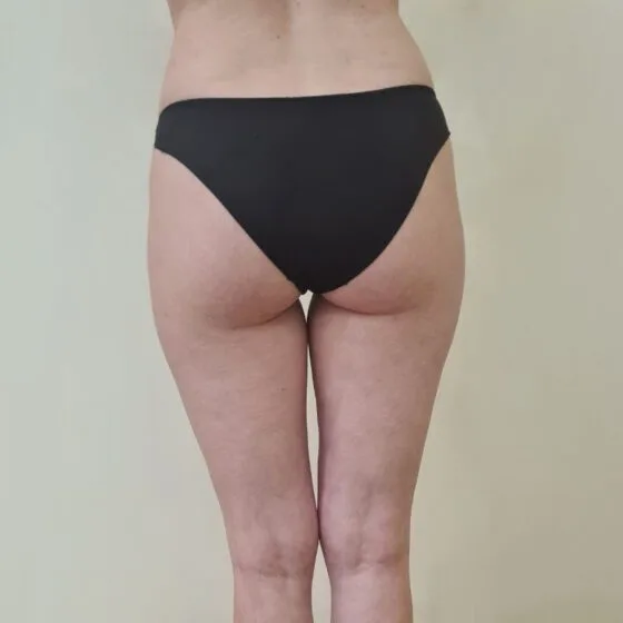 До/після процедури