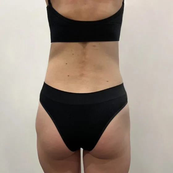 До/після процедури