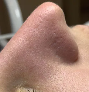 Комбінована чистка