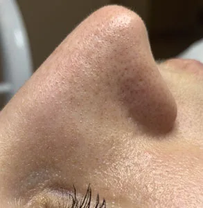 Комбінована чистка