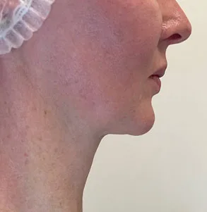 SMAS после процедуры