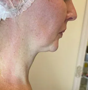 SMAS до процедуры