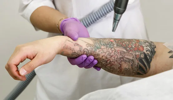 Видалення татуажу лазером