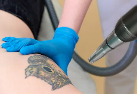 Видалення татуажу лазером