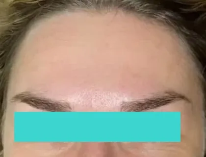 Ботокс після