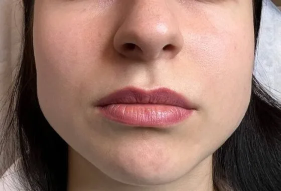 Контурна пластика