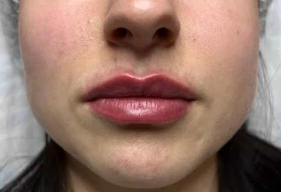 Контурна пластика