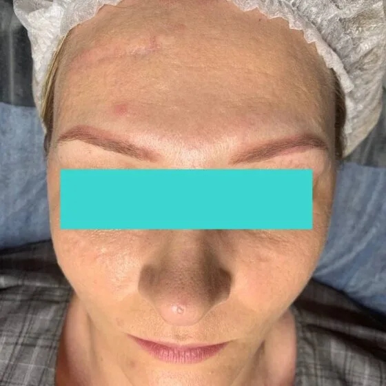 Карбоновий пілінг до