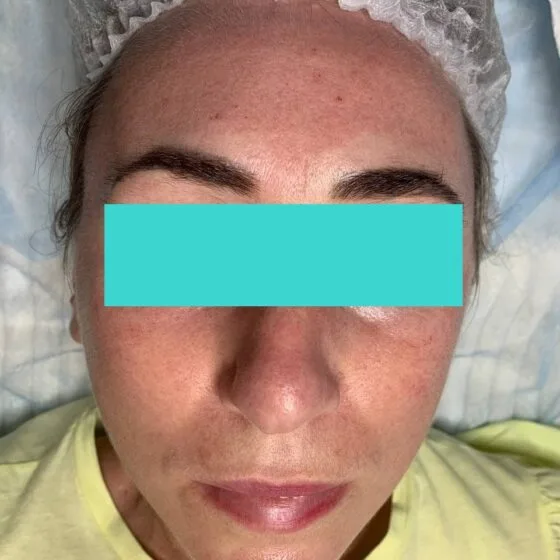 Карбоновий пілінг до