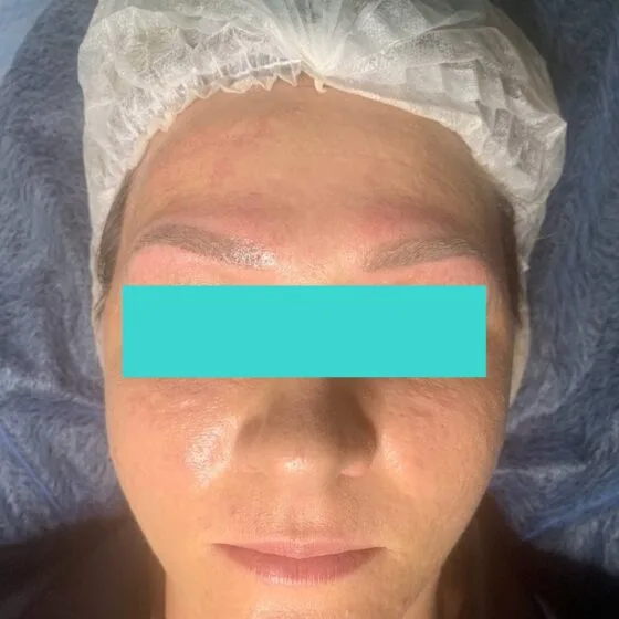 Карбоновий пілінг після