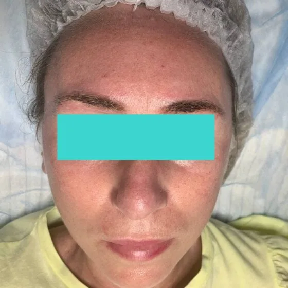 Карбоновий пілінг після