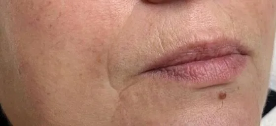 Контурна пластика препарат