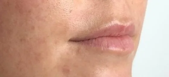 Контурна пластика препарат