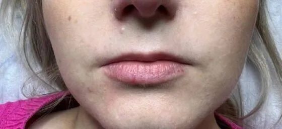 Контурна пластика