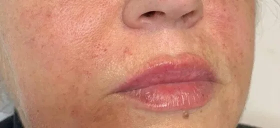 Контурна пластика препарат