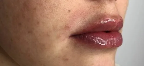 Контурна пластика препарат