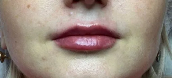 Контурна пластика