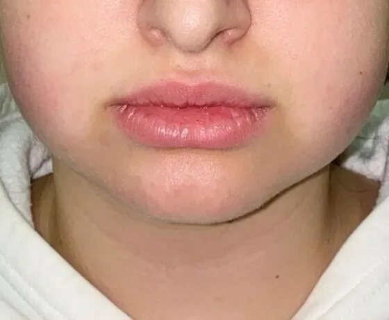 Ліпомоделювання