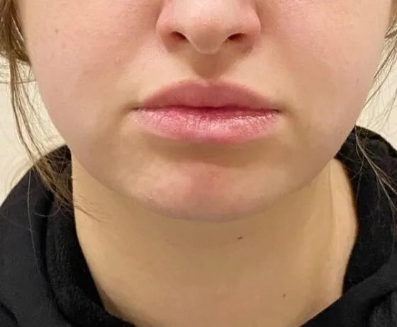 Ліпомоделювання