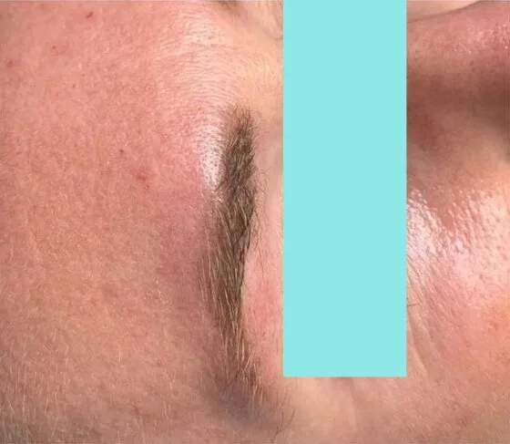 Після видалення перманентного макіяжу