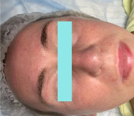 Після видалення перманентного макіяжу